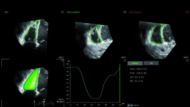 3D heart chamber analysis