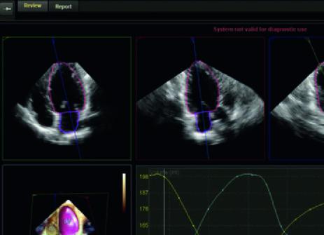 Right ventricular assessment