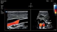 Blood flow in two planes