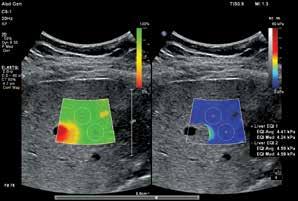 Liver stiffness measurement