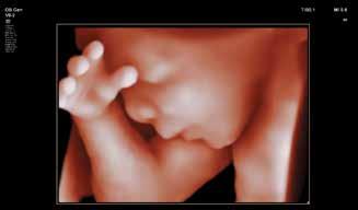 3D fetal surface imaging