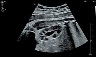 Fetal kidney detail