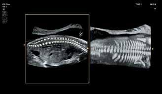 Fetal spine reconstruction