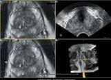 MRI and ultrasound fusion